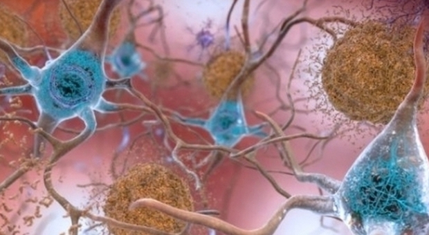 Alzheimer, una nuova cura da farmaco anti-Parkinson