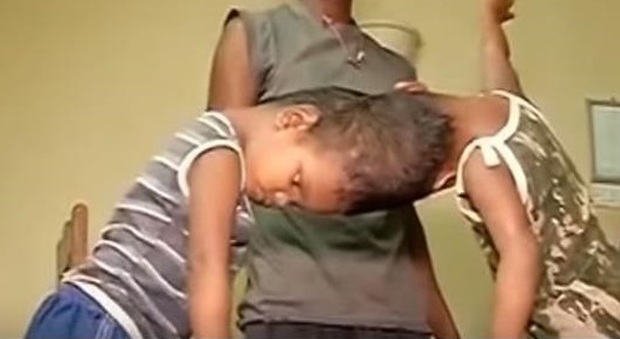 India, gemellini siamesi uniti dalla testa separati dopo un intervento durato 36 ore
