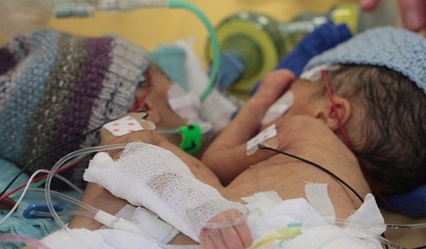 Berna, gemelline siamesi unite dal petto sopravvivono all'intervento: è il primo mai riuscito su bimbe di soli 8 giorni