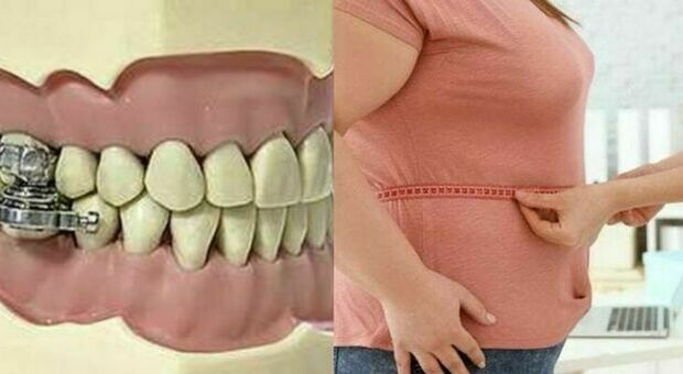 Bulloni nella bocca per non mangiare, progettato l'apparecchio estremo per combattere l'obesità