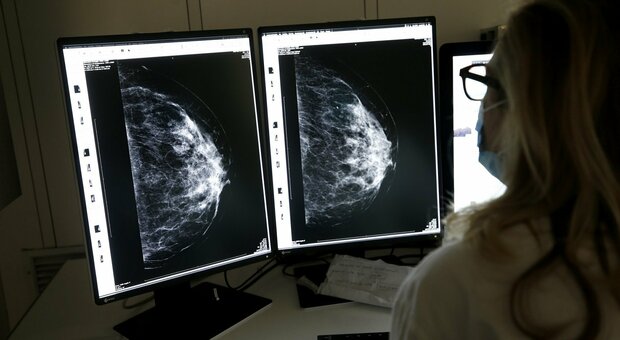Tumore al seno, nuova terapia mirata può allungare la vita: lo dice una ricerca condotta per 4 anni