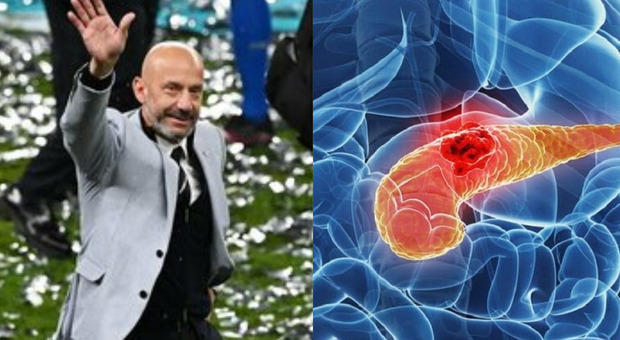 Tumore al pancreas, la malattia che ha ucciso Gianluca Vialli: «È il cancro più letale». Sintomi e cure