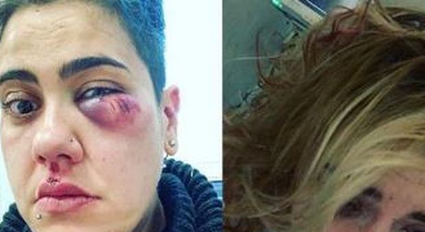 Seguita e picchiata in casa al agrido di «muori lesbica»: aggressione choc a Bolsena