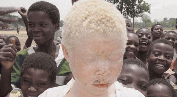 Ragazzo albino di 17 anni ucciso e mutilato: "Rubati arti e cervello". Il motivo è inquietante