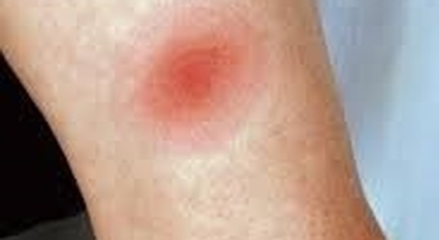 Bolla rossa sul ginocchio e mal di testa: «Malattia di Lyme ma i medici non mi hanno mai ascoltata»