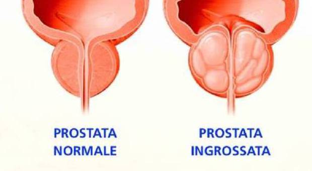 prostata problemi)