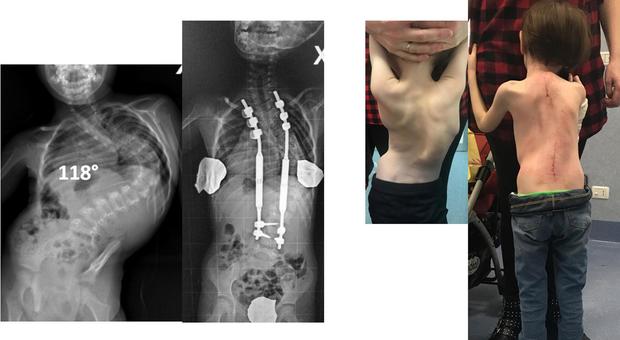 Scoliosi, bimba con grave malformazione salvata con barre magnetiche: «Intervento mini-invasivo e definitivo»
