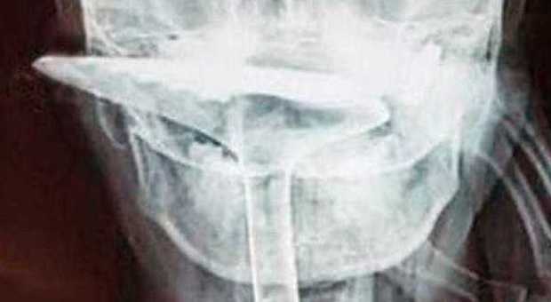Cina, non riesce a respirare e si infila una spatola in gola rischiando di morire: in ospedale le rimuovono parte dell'esofago