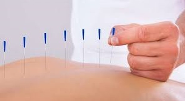 Per 30 donna vive con gli aghi da agopuntura infilati vicino alla spina dorsale