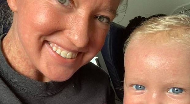 Mamma e figlio di un anno cacciati dall'aereo per una rara malattia alla pelle