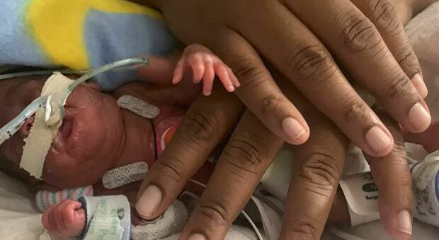 Bimbo nato prematuro più piccolo del mondo: il record del piccolo Curtis