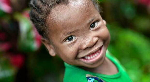 Operation Smile lancia appello per la cura delle malformazioni del volto: necessari interventi in Congo e Madagascar