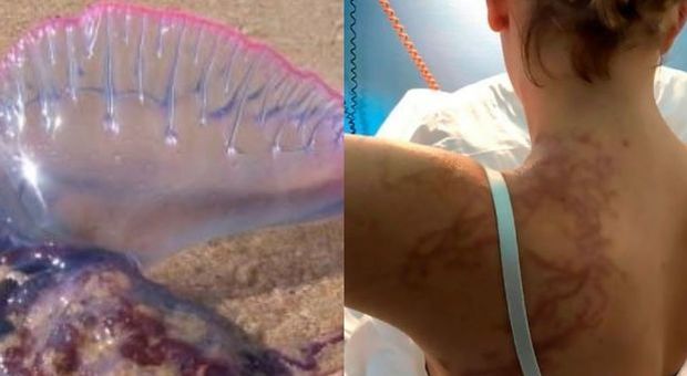 Medusa Man O'War attacca sette bagnanti: feriti e ricoverati in ospedale, terrore in spiaggia