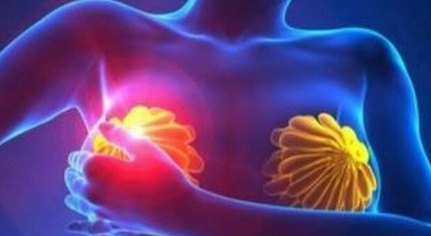 Tumore al seno, individuato gene che indica la predisposizione: lo studio dell'Università di Padova