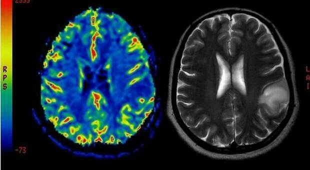 Sclerosi multipla, nuova cura con cellule staminali nel cervello: «Rallentano la malattia»