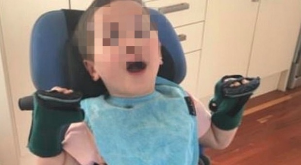 Bimbo di 2 anni soffoca con la mela a scuola: i medici lo salvano, ma rimane paralizzato