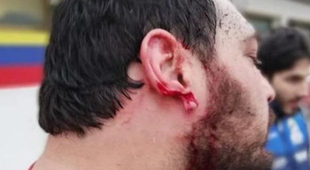 Rugby, orecchio staccato con un morso durante una mischia: 25enne condannato