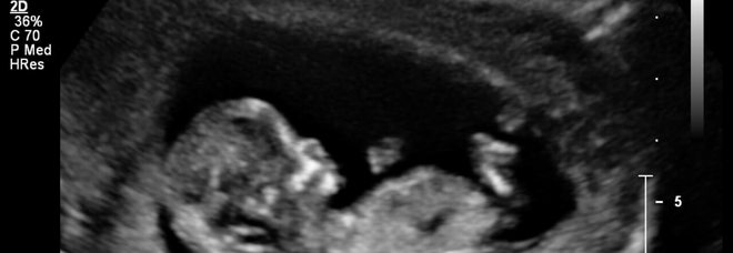 Anche in Kentucky le donne prima di abortire sono obbligate ad ascoltare il battito cardiaco del feto